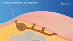 Why Pilonidal Sinus Recur?