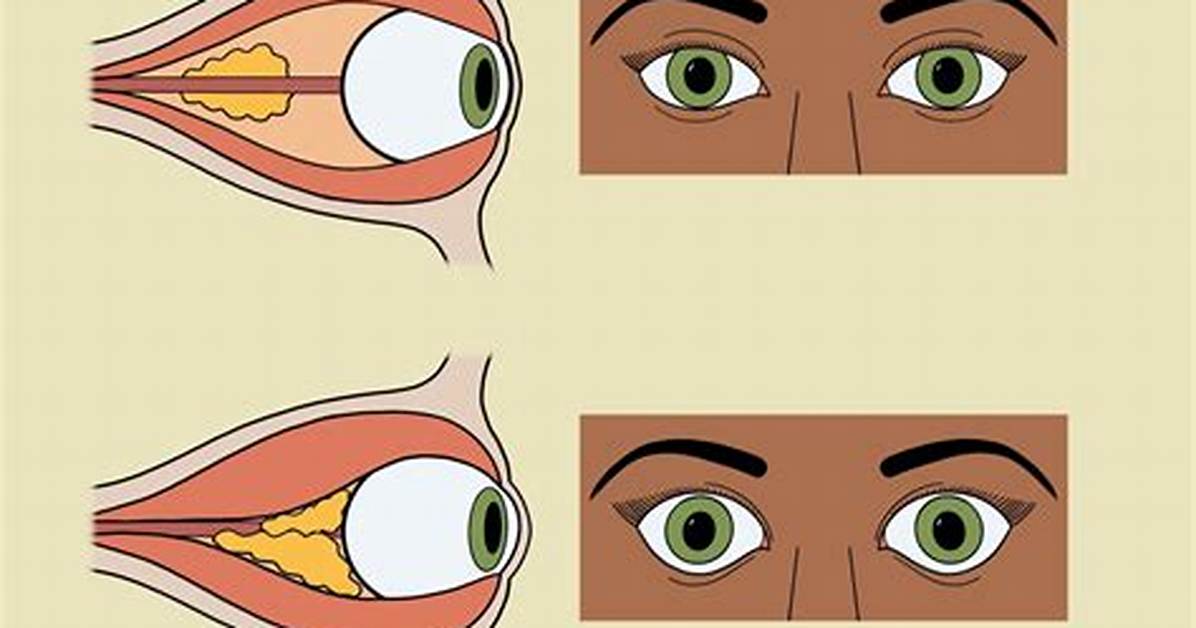 Why Proptosis in Hyperthyroidism?