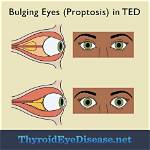 Why Proptosis in Hyperthyroidism?