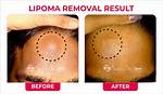 Why Remove a Lipoma?