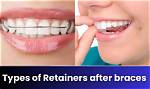 Why Retainers After Braces?