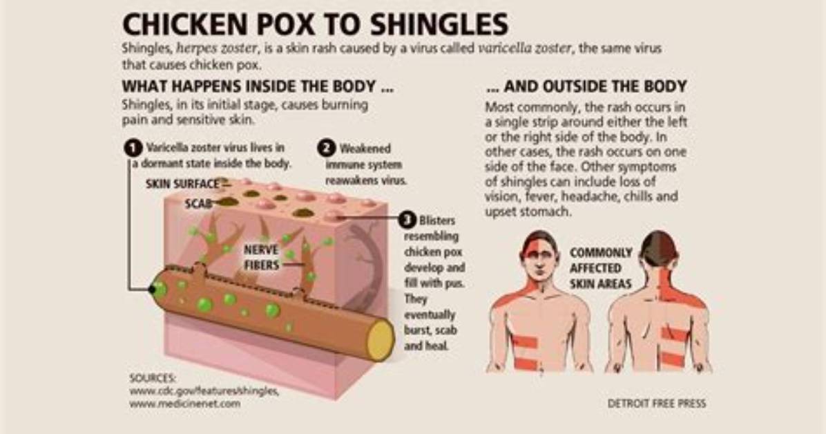 Why Shingles Keep Coming Back?