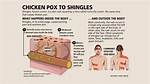 Why Shingles Keep Coming Back?