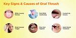 Why Thrush Keeps Coming Back?
