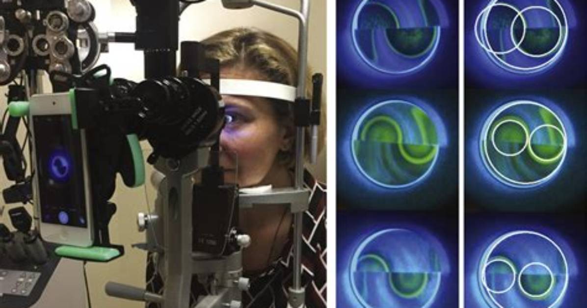 Why Use Applanation Tonometry?