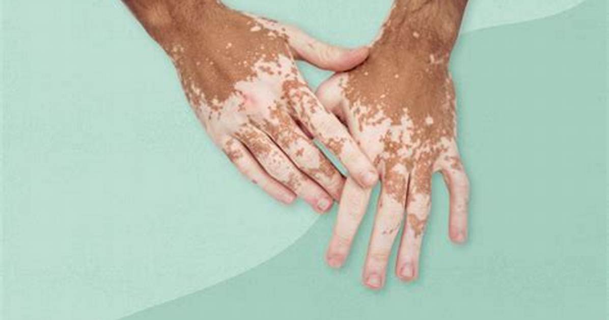 Why Vitiligo Cannot Be Cured?