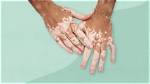 Why Vitiligo Cannot Be Cured?