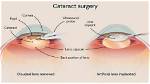 Why Wait to Remove Cataracts?