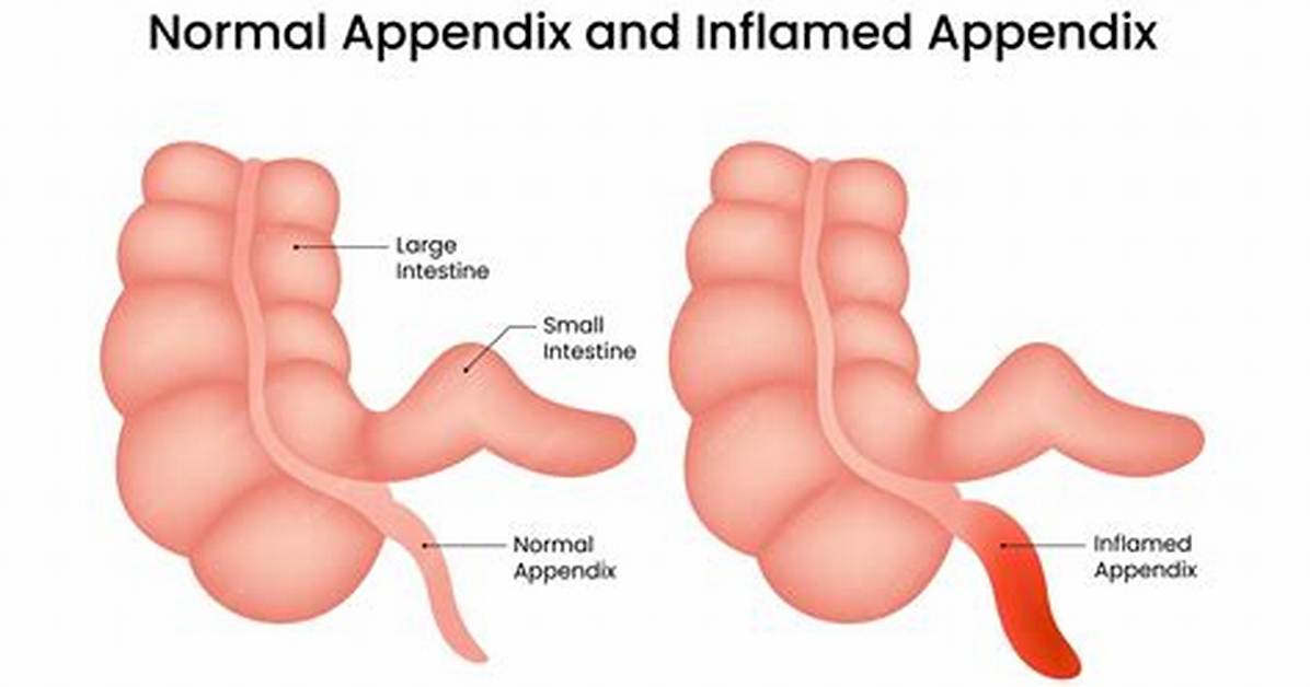 Why Would Appendix Be Inflamed?