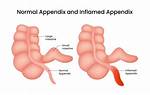 Why Would Appendix Be Inflamed?