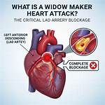 Widow Maker Artery