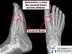 Will a Boot Help Sesamoiditis?