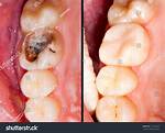 Will a Decayed Tooth Fall out?