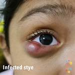 Will a Stye Ooze?