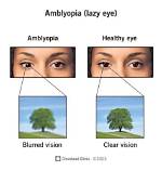 Will Amblyopia Cause Blindness?