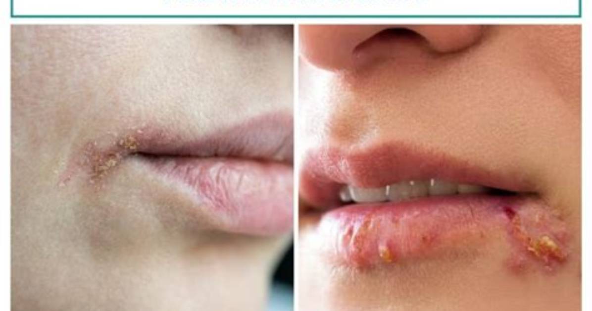 Will Angular Cheilitis Go Away?