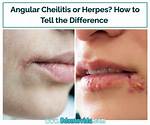 Will Angular Cheilitis Go Away?