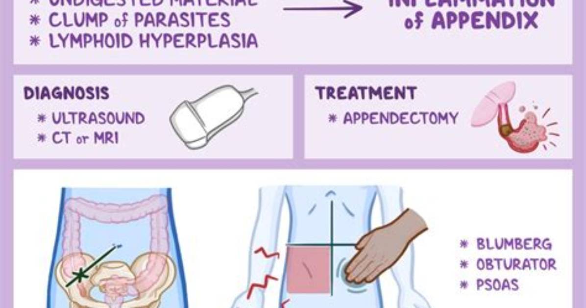 Will Appendicitis Kill You?