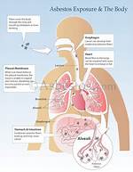 Will Asbestos Cause Copd?
