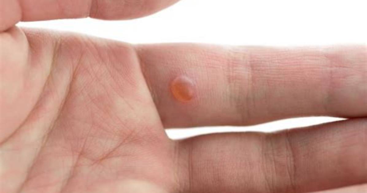 Will Bleach Kill Warts?