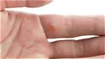 Will Bleach Kill Warts?