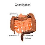 Will Bowel Resection Cause Constipation?