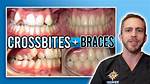 Will Braces Help My Crossbite?