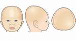 Will Brachycephaly Correct Itself?