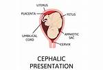 Will Cephalic Presentation Change?