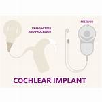 Will Cochlear Implants Cure Deafness?