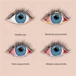 Will Conjunctivitis Go Away?