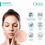 Will Dandruff Cause Pimples?
