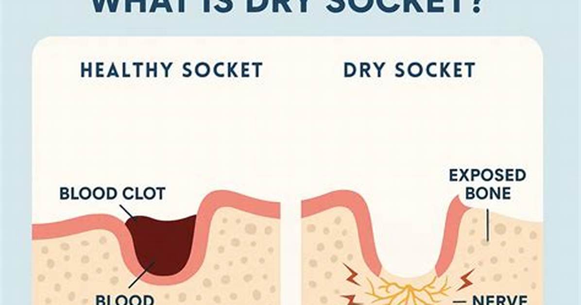 Will Dipping Cause Dry Socket?