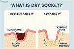 Will Dipping Cause Dry Socket?