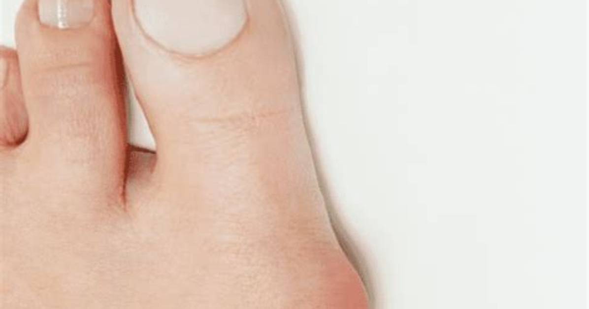 Will Dislocated Toe Heal Itself?