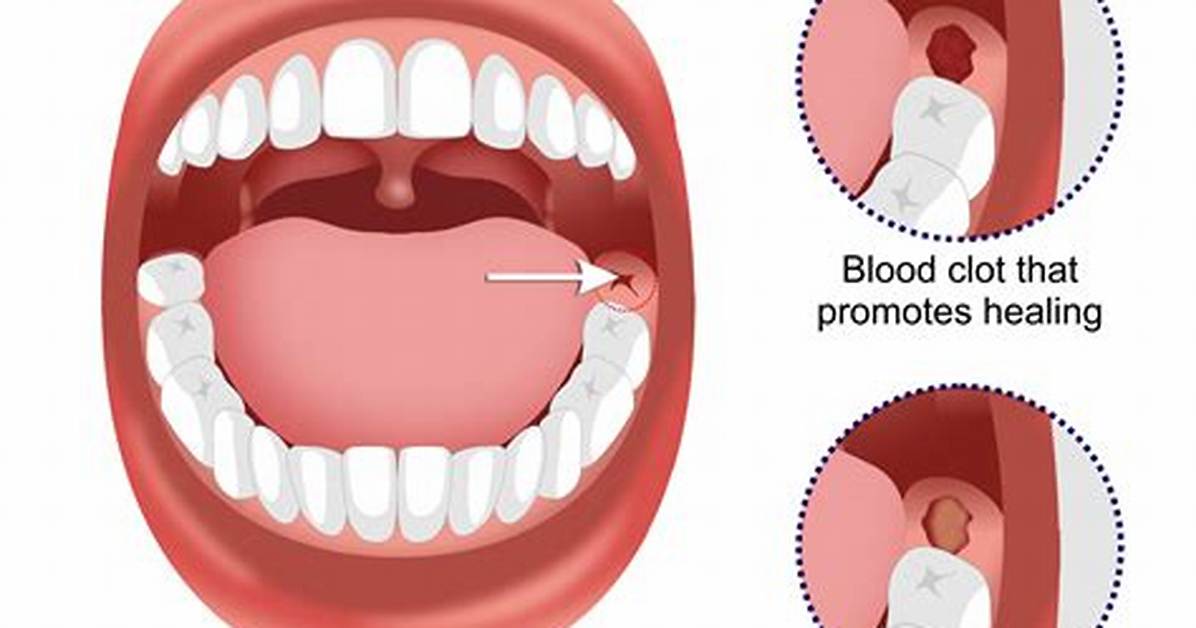 Will Dry Sockets Bleed?