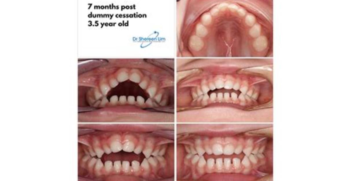 Will Dummy Affect Teeth?