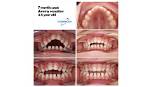Will Dummy Affect Teeth?