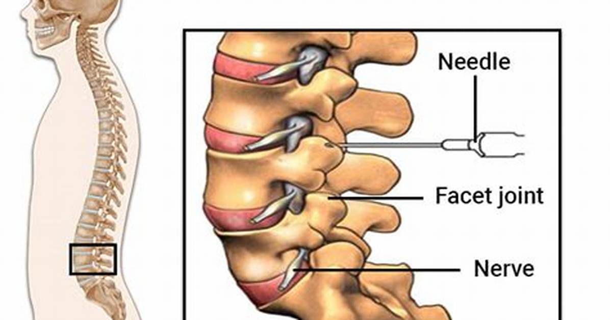 Will Facet Injections Help Sciatica?