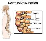 Will Facet Injections Help Sciatica?