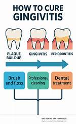 Will Flossing Cure Gingivitis?