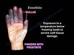 Will Frostbite Kill You?