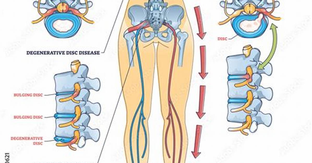 Will Leg Weakness from Sciatica Go Away?