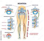 Will Leg Weakness from Sciatica Go Away?
