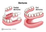 Will My Partial Denture Fall out?