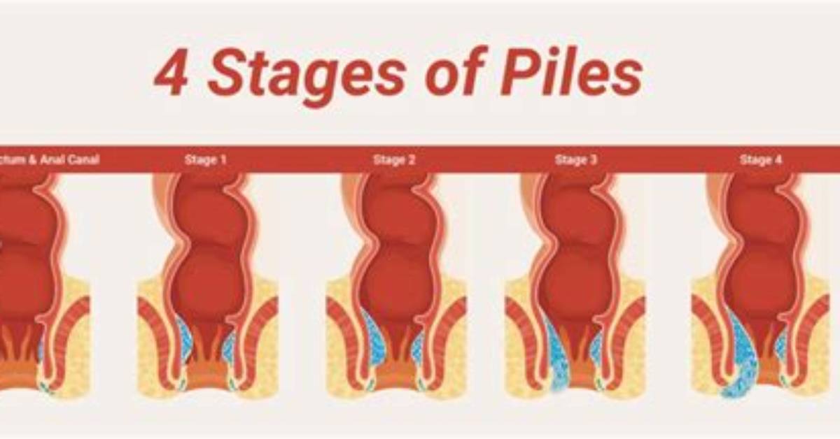 Will Piles Affect Normal Delivery?