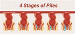 Will Piles Affect Normal Delivery?