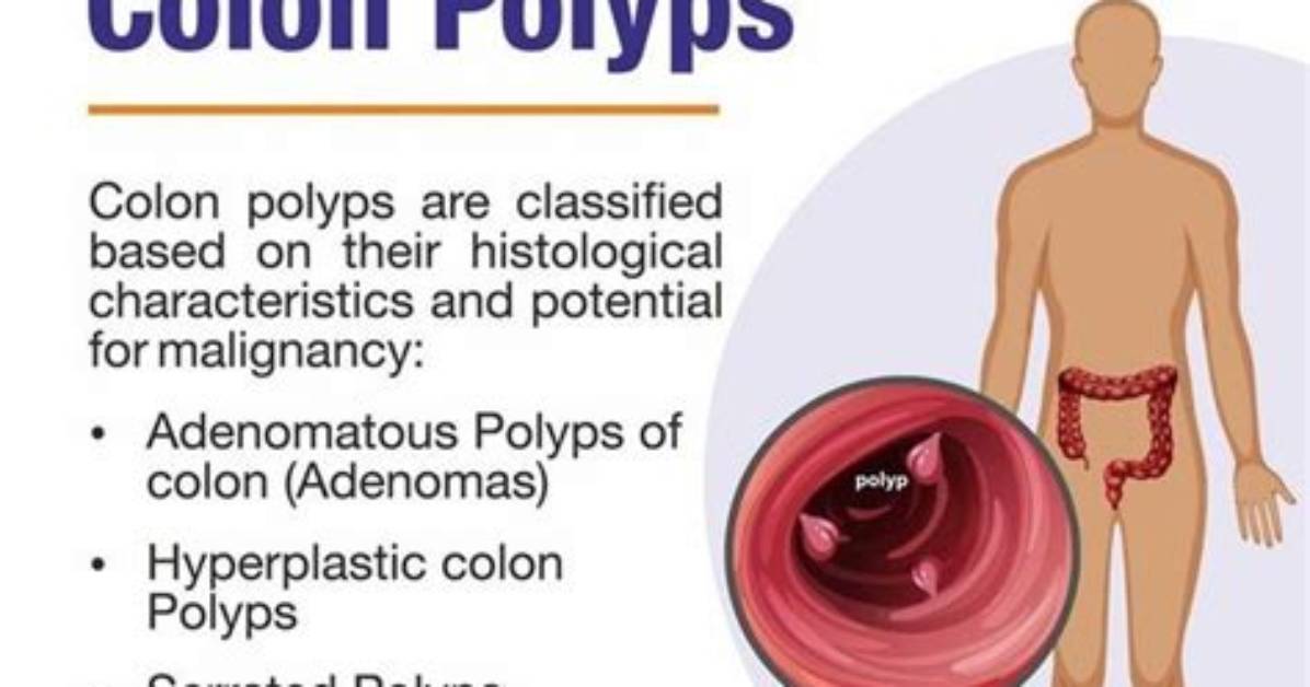 Will Polyps Go Away?