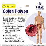 Will Polyps Go Away?
