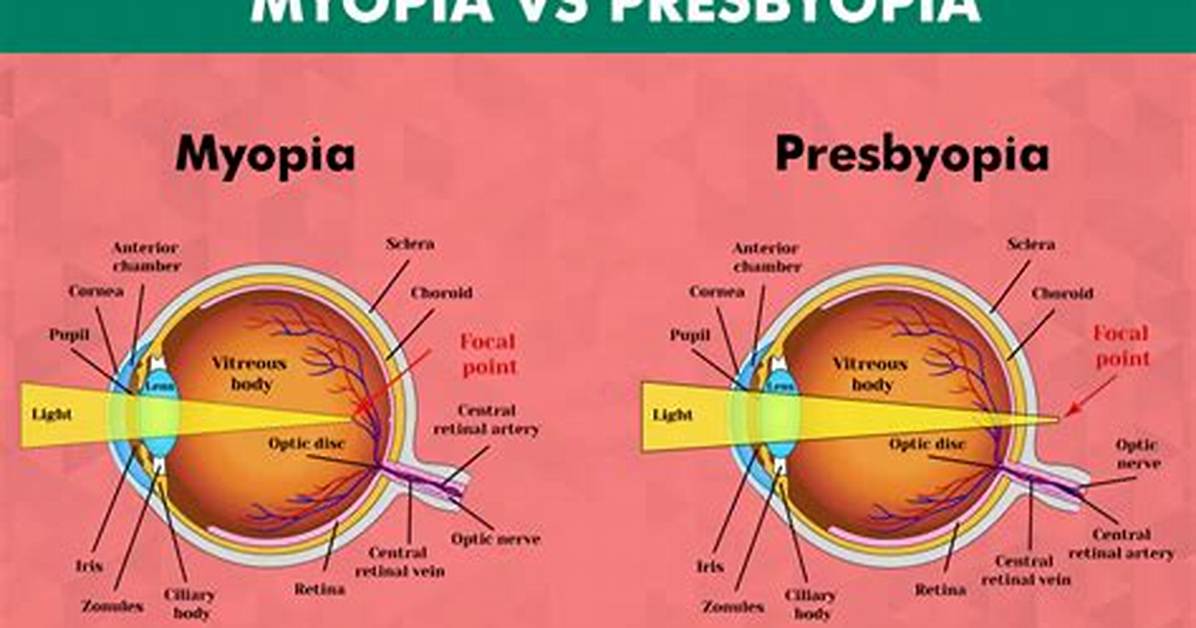 Will Presbyopia Offset Myopia?